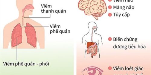 Bài tuyên truyền về phòng chống bệnh Sởi trong trường học Bài tuyên truyền về phòng chống bệnh Sởi trong trường học